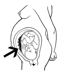 example of placental abruption
