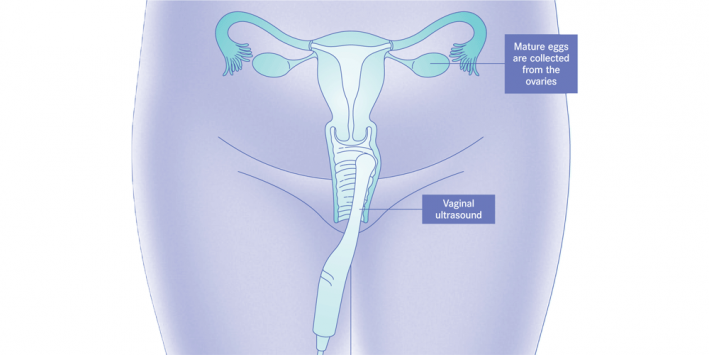 Ultrasound-guided aspiration procedure