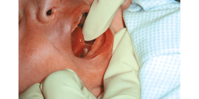 How to Tell if Your Baby is Tongue-Tied – Children's Health